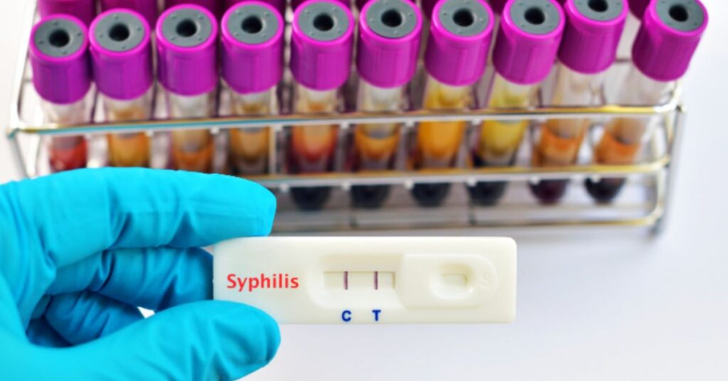 Teste laboratorial de sífilis congênita utilizado em pesquisa científica da Universidade de Fortaleza.