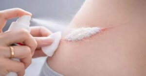 Cientistas criam spray para estancar hemorragia que age em 1 segundo